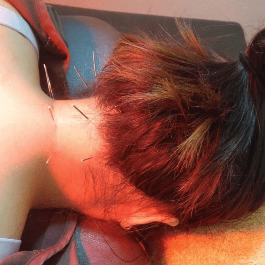 後頚部への施術